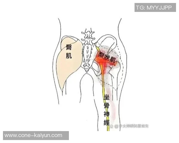 专家解读坐骨神经痛成因及治疗方法大多数患者可避免手术治疗